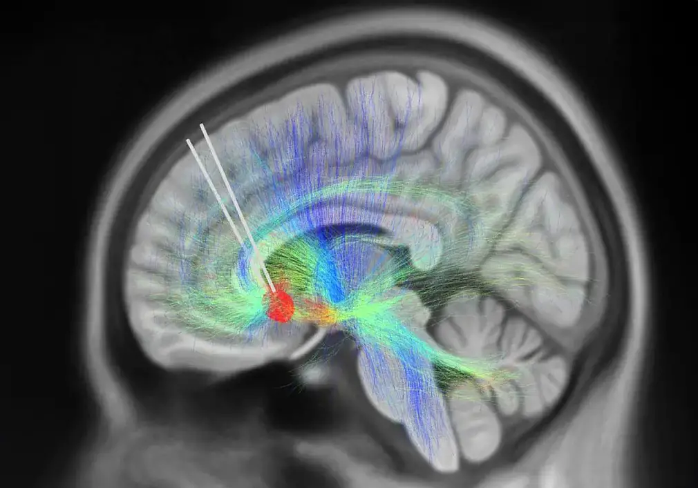 DBS Leads Implanted Into Subcallosal Cingulate Cortex neuronto